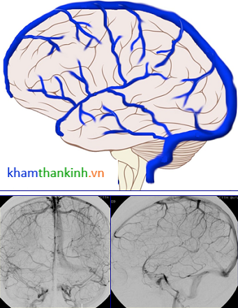 # CA LÂM SÀNG: Huyết khối tĩnh mạch não.